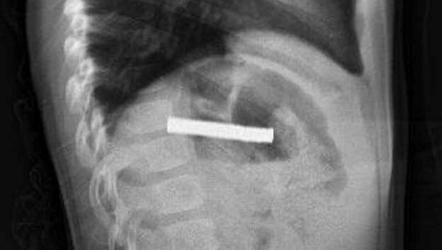 bogazindan 19 adet miknatis cikartildi OKpLVLph